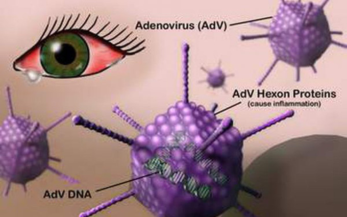 Adenovirus là nguyên nhân hay gặp nhất gây viêm kết mạc